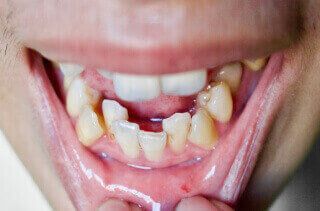 misaligned_teeth